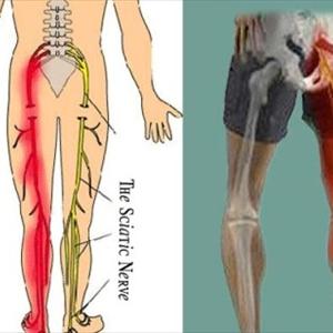 Exercises For Sciatic Pain - 3 Questions On Sciatica - Do You Know The "Right" Answers?