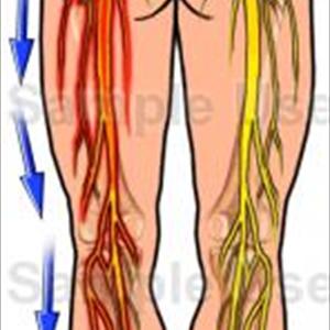 Sciatic Never Problems - How Can Magnetic Therapy Relieve Sciatica?