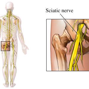 What Is Symptoms Bilateral Sciatica - A Guide To Exercises For Sciatica