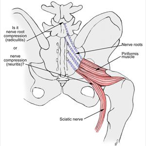 Sciatica Relief Exercises Treatments - An Overview Of Sciatica - Sciatica Pain Relief Jacksonville