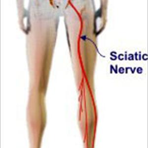 Sciatica Problem - 3 Simple Tests For Back Pain