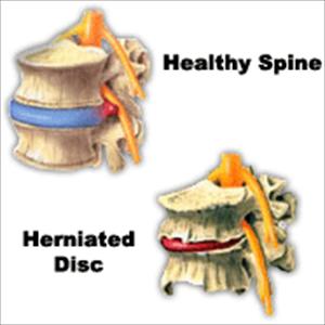 Pseudo Sciatica Gluteus Minimus - Top 7 Tips To Treat And Prevent Sciatica