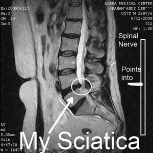 Sciatic Nerve Diagram Chat - Sciatica Exercises That Relieve Back Pain