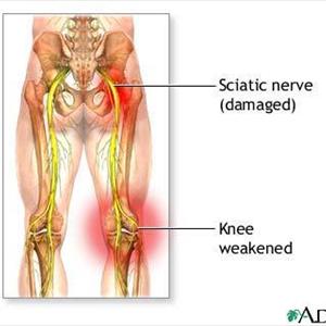 Cortisone Injections For Sciatic Nerve - How Can Magnetic Therapy Relieve Sciatica?