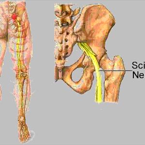 Pinched Sciatic Nerve Spine - Chiropractor, Tampa: Low Back Pain And Sciatica.